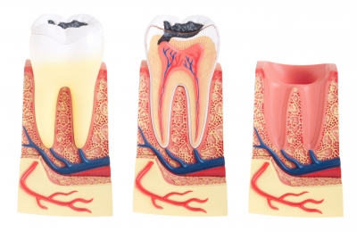 Ocean Dental Associates root canal therapy