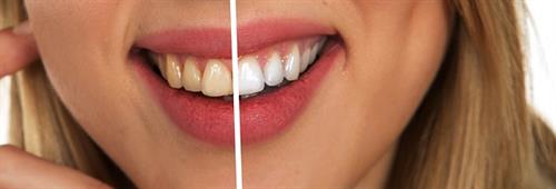 Tooth Whitening Ocean Dental Associates
